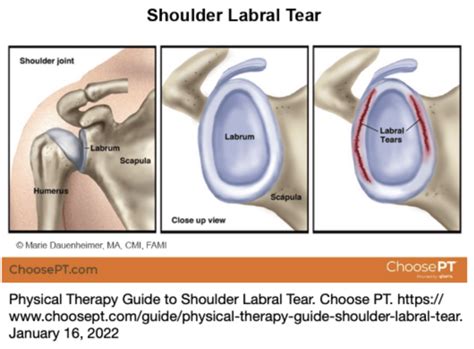 shoulder slap tear diagnosis